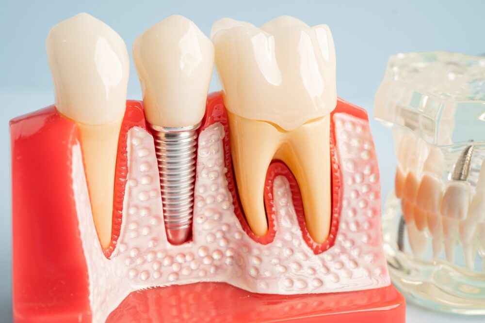 Dental Implants Allen